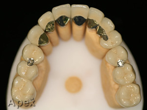 Apex Dental Centre Pty Ltd Pic 4 - crowns and bridges