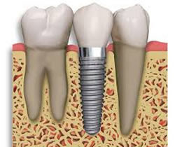 Apex Dental Centre Pty Ltd Pic 3 - Dental implants