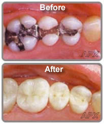 Apex Dental Centre Pty Ltd Pic 5 - White fillings