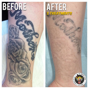 MJ Driver Laser Tattoo Removal & Lightening - MELBOURNE Pic 5