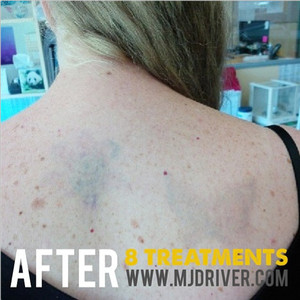 MJ Driver Laser Tattoo Removal & Lightening - MELBOURNE Pic 3