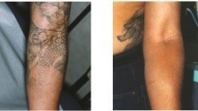 Melbourne Tatt Removal Pic 1 - Before and After shots