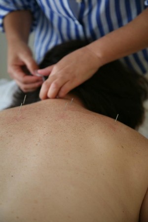 I Can Change Pic 3 - Acupuncture