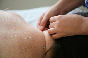 I Can Change Pic 4 - Acupuncture for Health Healing