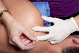 Robina Physiotherapy Clinic Pic 3 - Acupunture