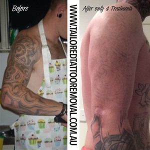 Tailored Tattoo Removal Pic 4