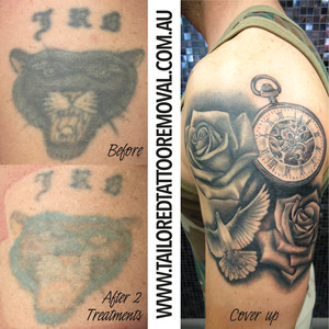 Tailored Tattoo Removal Pic 5