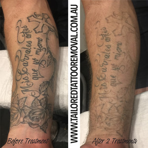 Tailored Tattoo Removal Pic 3