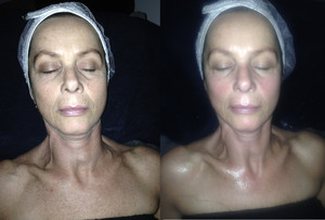 aHead Hair & Beauty Pic 5 - Alison before and after the dermalogica Active Resurface Skin Treatment with Nicola