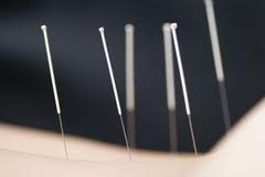 Art of Chinese Medicine Pic 1 - Acupuncture