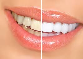 SkinDeep Dermal Clinic Pic 3 - Teeth Whitening Show me your teeth