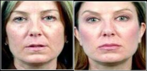 Heber Davis Skin Clinic Pic 3 - Dermal fillers for wrinkles and revolumising