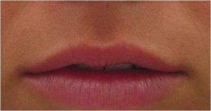 Heber Davis Skin Clinic Pic 5 - Lips before augmentation