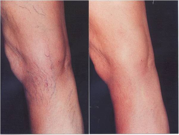 Heber Davis Skin Clinic Pic 1 - Saline sclerotherapy