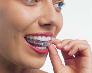 Cherrygum Dental Pic 5 - Invisalign the cosmetic way to move teeth