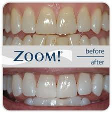 Cherrygum Dental Pic 3 - Zoom Whitening 1 hour in the chair