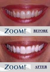 Cherrygum Dental Pic 4 - Zoom Whitening dramatic results