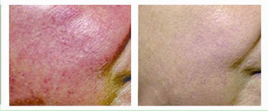 Spider Vein Removal Pic 1