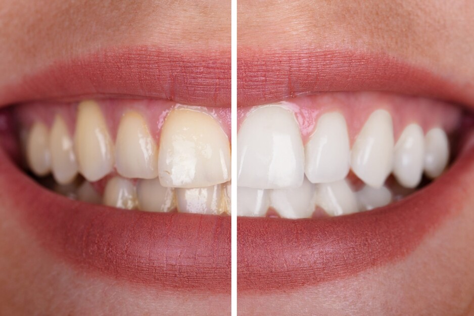 Bayswater Dentist Pic 1 - Get a zoom whitening treatment with advanced technology and professional knowledge