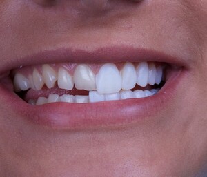 Bayswater Dentist Pic 3 - want a perfect smile visit bayswater dentist for cosmetic dental tratment