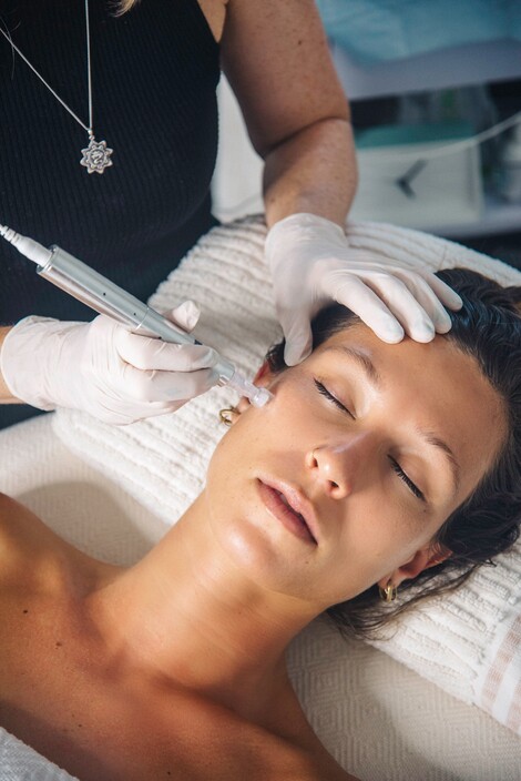 Kopru Rituals Pic 1 - Twice FDA approved clincal skin Needling to target acne scarring and collagen induction for anti ageing