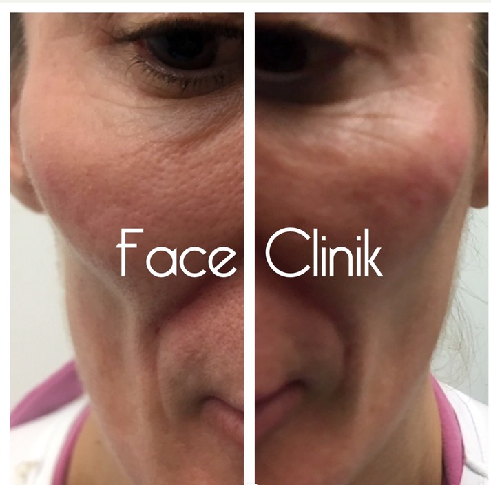 Face Clinik Pic 1 - Cheek fillers