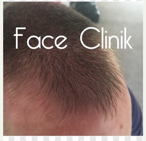 Face Clinik Pic 2 - Prp for hair loss