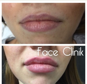 Face Clinik Pic 3 - Lip filler