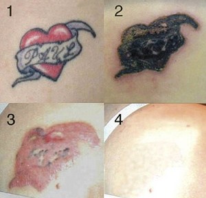 Cosmetic Ink - Sydney Tattoo Removal Pic 4 - tattoo removal