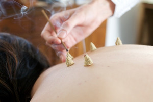 Haynes Acupuncture Pic 2 - Moxibustion