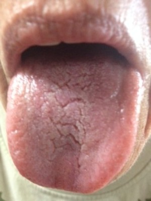 Infinitehope Pic 3 - Ayurvedic tongue diagnosis