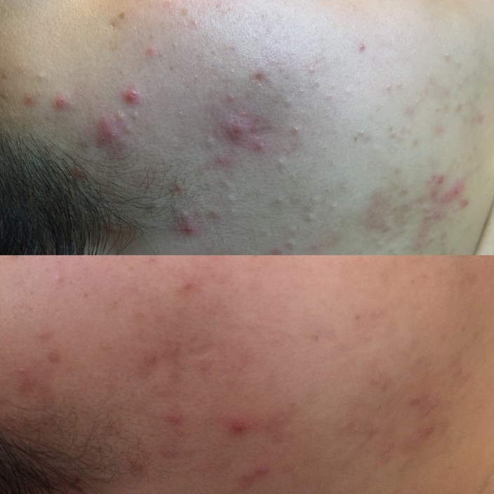 Quintessential Health & Beauty Centre Pic 1 - Acne treatment with Herbal Aktive Peel skin before and 4 weeks after 1st treatment