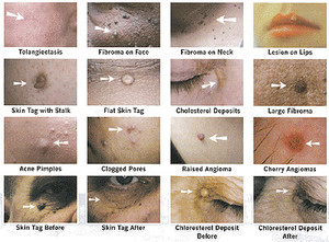 Quintessential Health & Beauty Centre Pic 3 - Minor skin lesion removal