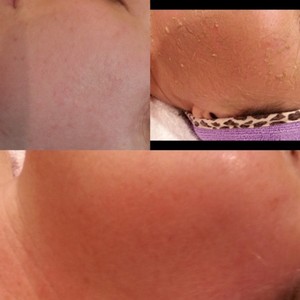 Quintessential Health & Beauty Centre Pic 2 - Scar treatment with 1 Herbal Aktiv Peel 6 days after peel