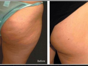 Laila's Beauty & Laser Pic 2 - Vela Smooth cellulite reduction and skin firming toning and reshaping