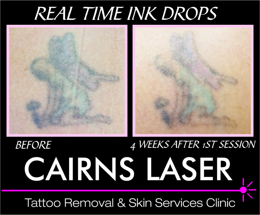 Cairns Laser Pic 1 - Have your Tattoo Removed by a Radiation Health QLD Accredited Technician Book your free consultation today to discuss your tattoo removal options