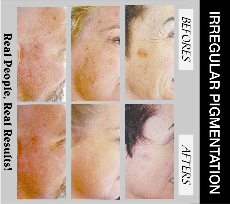 Cairns Laser Pic 2 - Irregular Pigmentation from sun damage age spots freckles birth marks etc CAIRNS LASER can remove or lighten irregular pigmentation Call or book online your free consultation to discuss your pigmentation and removal options