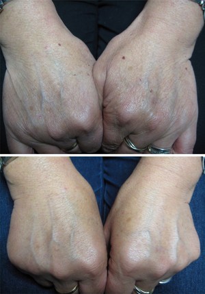 Head To Toe Body Care Centre For Men & Women Pic 5 - Pigmentation Removal on Hands