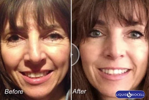 Liquid Biocell Collagen Pic 5 - Liquid BioCell Collagen Before After