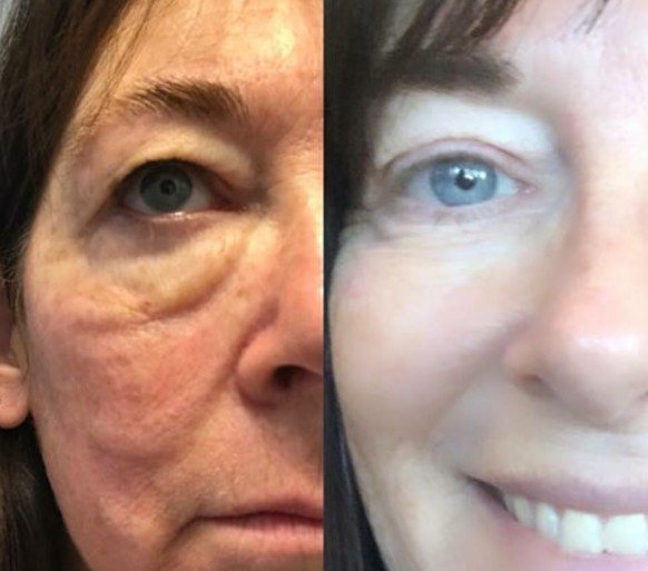 Liquid Biocell Collagen Pic 1 - Liquid BioCell Collagen Before After