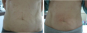 Skin Deep Clinique Pic 3 - Rejuvastamp needling treatment