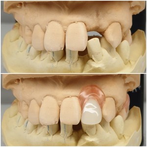 A Plus Denture Clinic Pic 3 - 1 Tooth Flexible Denture