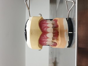 A Plus Denture Clinic Pic 2 - Full Upper denture and Partial Lower