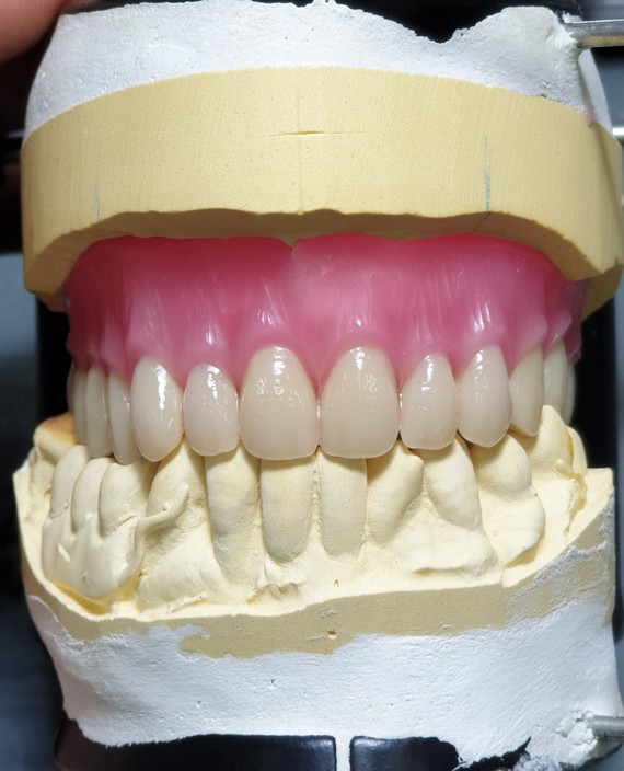 A Plus Denture Clinic Pic 1 - Life Like Full Upper Denture