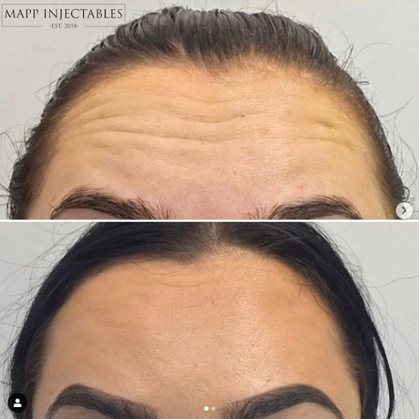 Mapp Injectables Pic 1 - Sydney antiwrinkle botox treatment for forehead and crowsfeets in sutherland shire