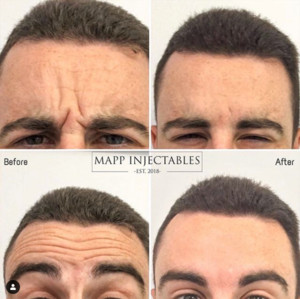 Mapp Injectables Pic 3 - Sydney mens botox treatment injections