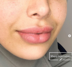 Mapp Injectables Pic 2 - Lip filler in sydney for fuller lips