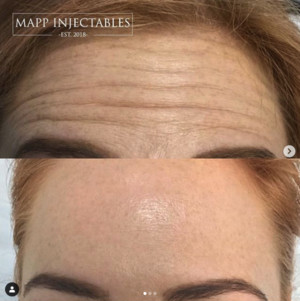 Mapp Injectables Pic 5 - Antiwrinkle botox injections for forehead and crowsfeets