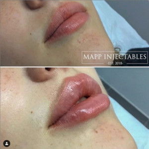 Mapp Injectables Pic 4 - russian doll and cupids bow lips with a keyhole