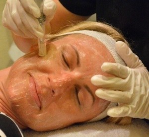 infuse skin clinic Pic 3 - Collagen Induction Therapy